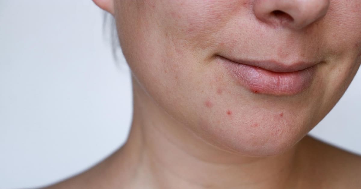 Qué alimentos provocan acné